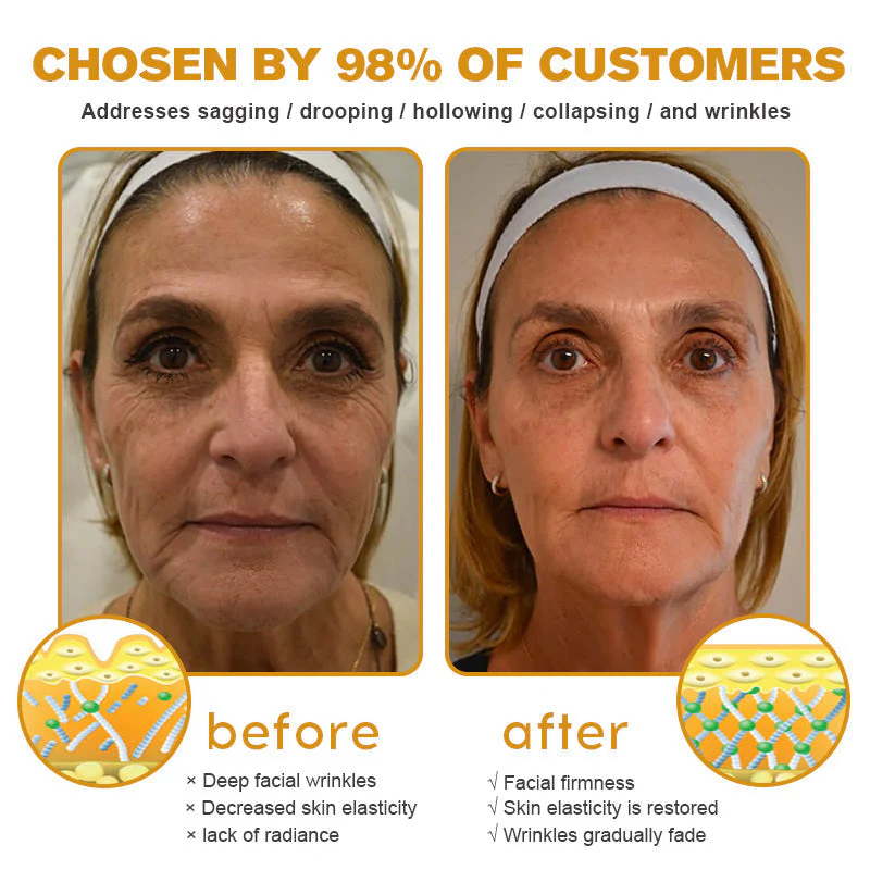 👨⚕️ Botox Bee Venom Wrinkle Removal Cream- LAST DAY 70% OFF✅